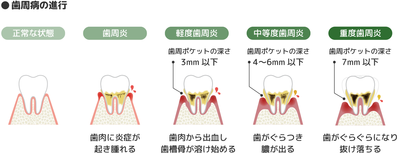 歯周病の進行